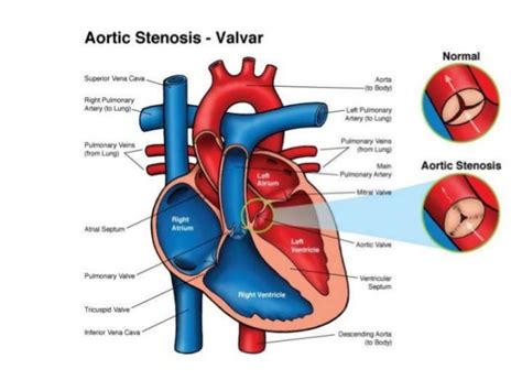 left ventricular outlet tract obstruction.